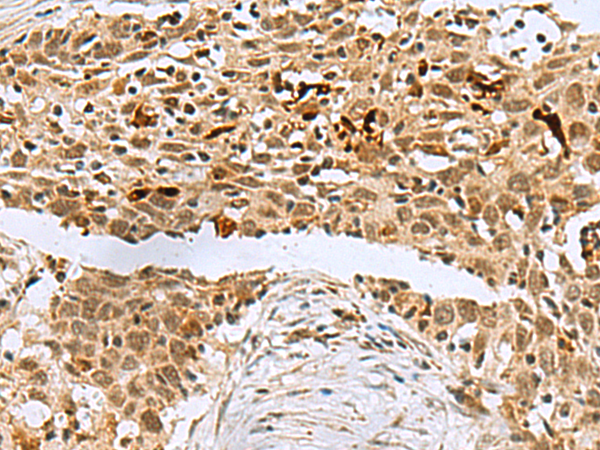 Immunohistochemistry of paraffin-embedded Human esophagus cancer tissue  using BCL7B Polyclonal Antibody at dilution of 1:60(×200)