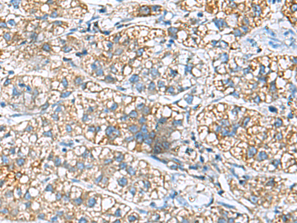 Immunohistochemistry of paraffin-embedded Human liver cancer tissue  using JOSD1 Polyclonal Antibody at dilution of 1:90(×200)