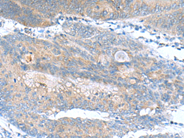 Immunohistochemistry of paraffin-embedded Human colorectal cancer tissue  using JOSD1 Polyclonal Antibody at dilution of 1:90(×200)