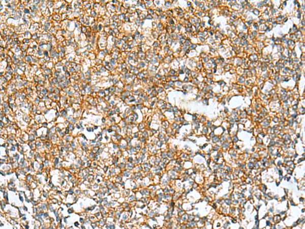 Immunohistochemistry of paraffin-embedded Human tonsil tissue  using RAB13 Polyclonal Antibody at dilution of 1:50(×200)