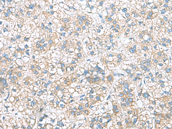 Immunohistochemistry of paraffin-embedded Human liver cancer tissue  using RAB13 Polyclonal Antibody at dilution of 1:50(×200)