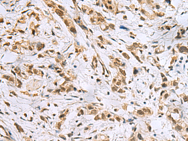 Immunohistochemistry of paraffin-embedded Human gastric cancer tissue  using NABP1 Polyclonal Antibody at dilution of 1:50(×200)