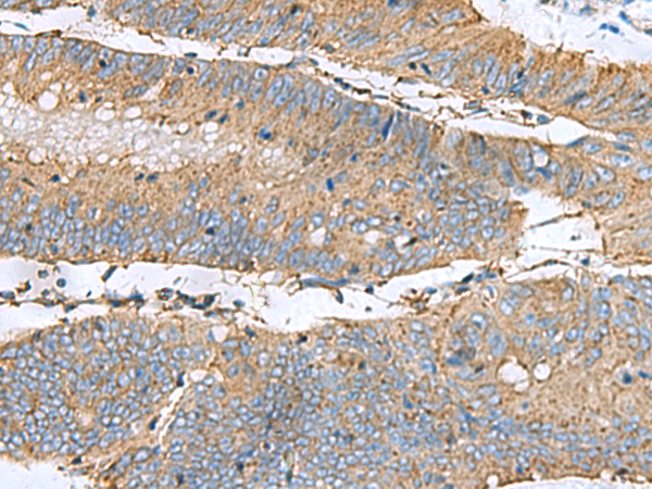 Immunohistochemistry of paraffin-embedded Human colorectal cancer tissue  using CLTB Polyclonal Antibody at dilution of 1:60(×200)