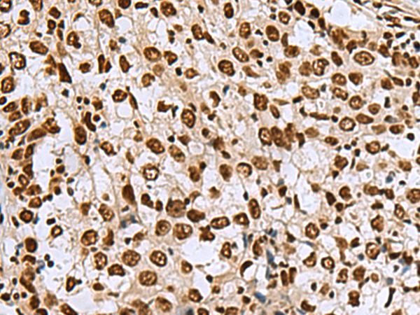 Immunohistochemistry of paraffin-embedded Human esophagus cancer tissue  using MYEF2 Polyclonal Antibody at dilution of 1:70(×200)