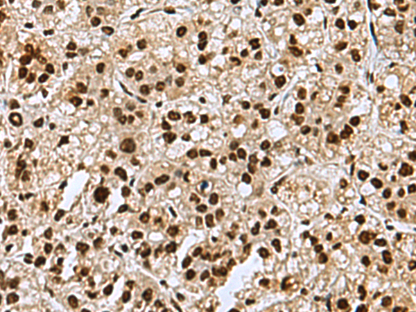 Immunohistochemistry of paraffin-embedded Human liver cancer tissue  using MYEF2 Polyclonal Antibody at dilution of 1:70(×200)