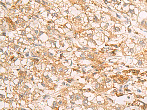 Immunohistochemistry of paraffin-embedded Human liver cancer tissue  using RAB38 Polyclonal Antibody at dilution of 1:50(×200)