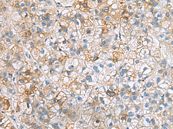 Immunohistochemistry of paraffin-embedded Human liver cancer tissue  using IGLL1 Polyclonal Antibody at dilution of 1:50(×200)