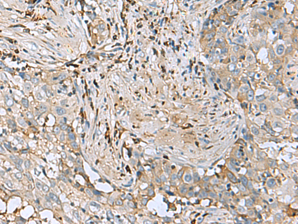 Immunohistochemistry of paraffin-embedded Human esophagus cancer tissue  using IGLL1 Polyclonal Antibody at dilution of 1:50(×200)