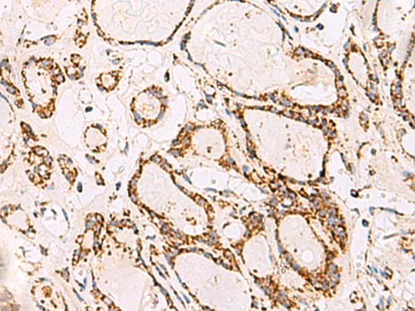 Immunohistochemistry of paraffin-embedded Human thyroid cancer tissue  using ATP5O Polyclonal Antibody at dilution of 1:90(×200)