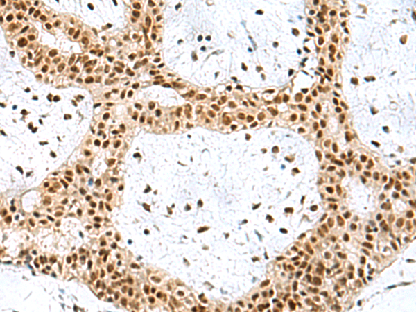 Immunohistochemistry of paraffin-embedded Human breast cancer tissue  using PRPF40A Polyclonal Antibody at dilution of 1:60(×200)