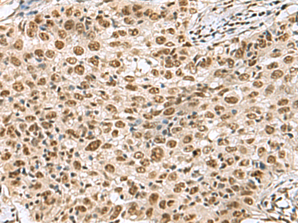 Immunohistochemistry of paraffin-embedded Human esophagus cancer tissue  using PRPF40A Polyclonal Antibody at dilution of 1:60(×200)