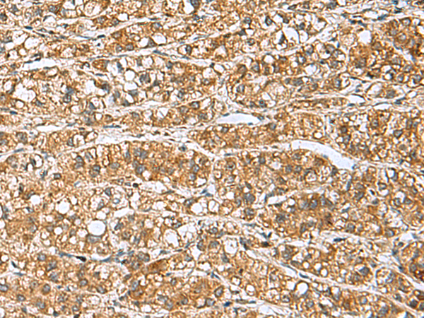 Immunohistochemistry of paraffin-embedded Human liver cancer tissue  using GINS3 Polyclonal Antibody at dilution of 1:60(×200)