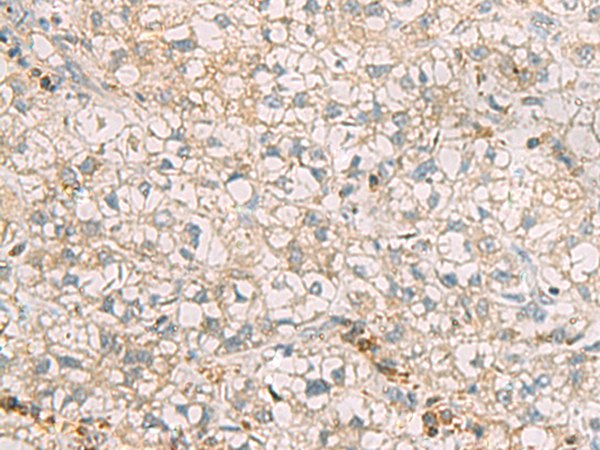 Immunohistochemistry of paraffin-embedded Human liver cancer tissue  using SLC30A6 Polyclonal Antibody at dilution of 1:70(×200)