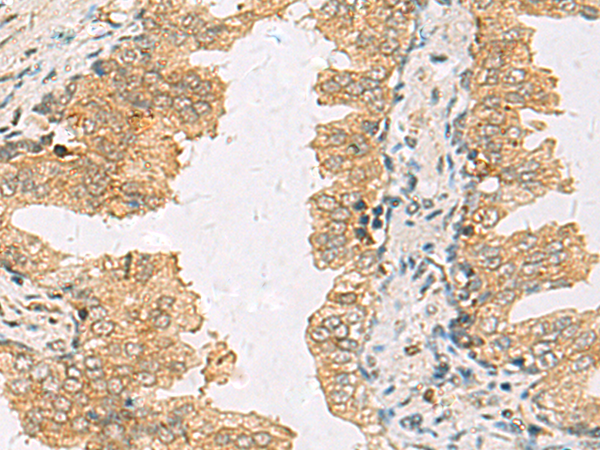 Immunohistochemistry of paraffin-embedded Human prost ate cancer tissue  using SLC30A6 Polyclonal Antibody at dilution of 1:70(×200)