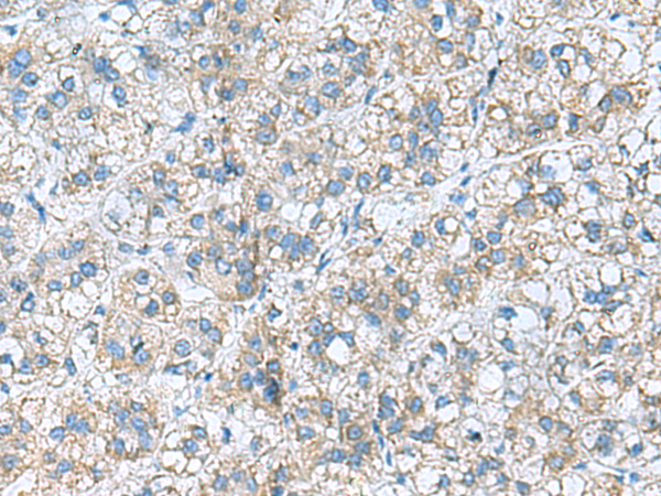 Immunohistochemistry of paraffin-embedded Human liver cancer tissue  using RPL10A Polyclonal Antibody at dilution of 1:50(×200)