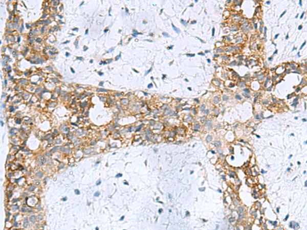 Immunohistochemistry of paraffin-embedded Human breast cancer tissue  using RPL10A Polyclonal Antibody at dilution of 1:50(×200)