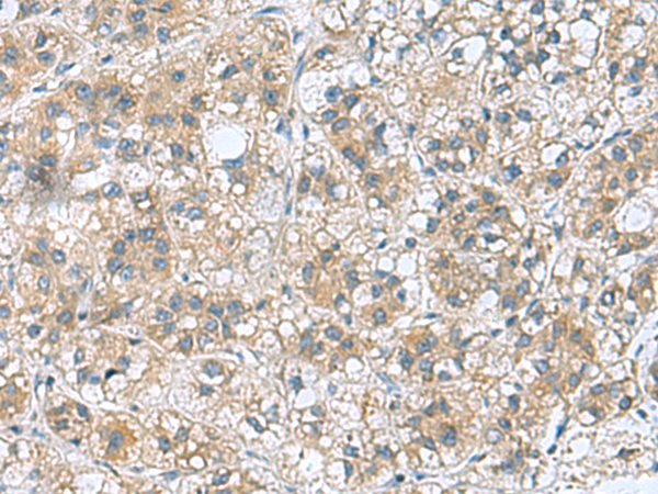 Immunohistochemistry of paraffin-embedded Human liver cancer tissue  using RAB39A Polyclonal Antibody at dilution of 1:70(×200)