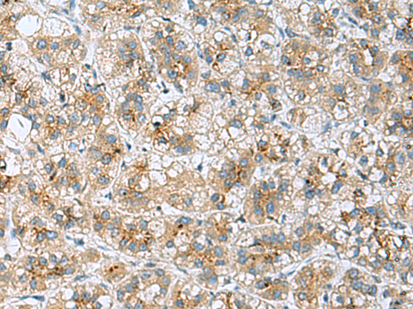 Immunohistochemistry of paraffin-embedded Human liver cancer tissue  using TMED10 Polyclonal Antibody at dilution of 1:50(×200)