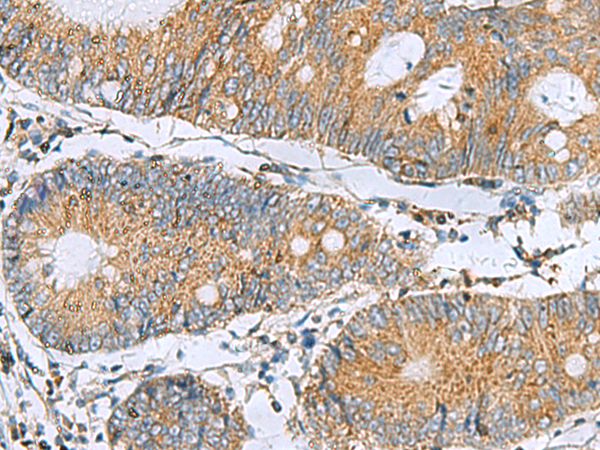 Immunohistochemistry of paraffin-embedded Human colorectal cancer tissue  using TMED10 Polyclonal Antibody at dilution of 1:50(×200)
