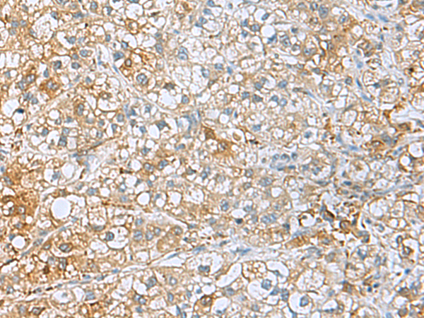 Immunohistochemistry of paraffin-embedded Human liver cancer tissue  using UCHL1 Polyclonal Antibody at dilution of 1:50(×200)
