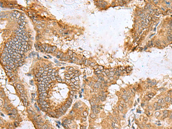 Immunohistochemistry of paraffin-embedded Human thyroid cancer tissue  using CCDC134 Polyclonal Antibody at dilution of 1:50(×200)