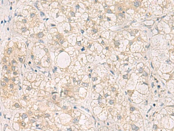 Immunohistochemistry of paraffin-embedded Human liver cancer tissue  using LRAT Polyclonal Antibody at dilution of 1:50(×200)