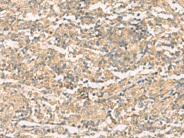 Immunohistochemistry of paraffin-embedded Human tonsil tissue  using NQO2 Polyclonal Antibody at dilution of 1:50(×200)