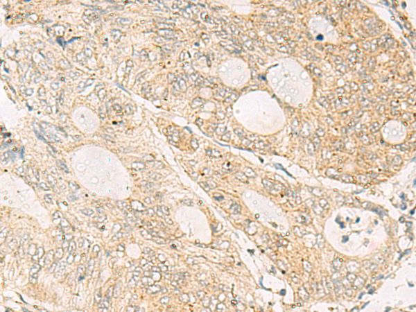 Immunohistochemistry of paraffin-embedded Human colorectal cancer tissue  using NQO2 Polyclonal Antibody at dilution of 1:50(×200)