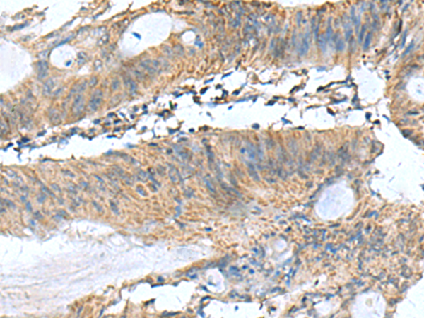 Immunohistochemistry of paraffin-embedded Human colorectal cancer tissue  using PAFAH1B3 Polyclonal Antibody at dilution of 1:60(×200)