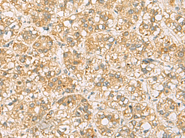 Immunohistochemistry of paraffin-embedded Human liver cancer tissue  using FAAP100 Polyclonal Antibody at dilution of 1:65(×200)