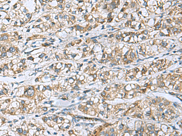 Immunohistochemistry of paraffin-embedded Human liver cancer tissue  using DNAJA4 Polyclonal Antibody at dilution of 1:50(×200)