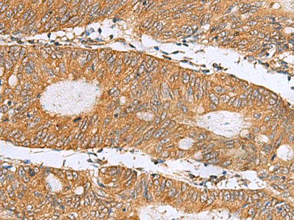 Immunohistochemistry of paraffin-embedded Human colorectal cancer tissue  using DNAJA4 Polyclonal Antibody at dilution of 1:50(×200)