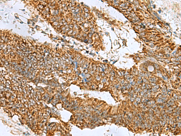 Immunohistochemistry of paraffin-embedded Human colorectal cancer tissue  using PREPL Polyclonal Antibody at dilution of 1:60(×200)