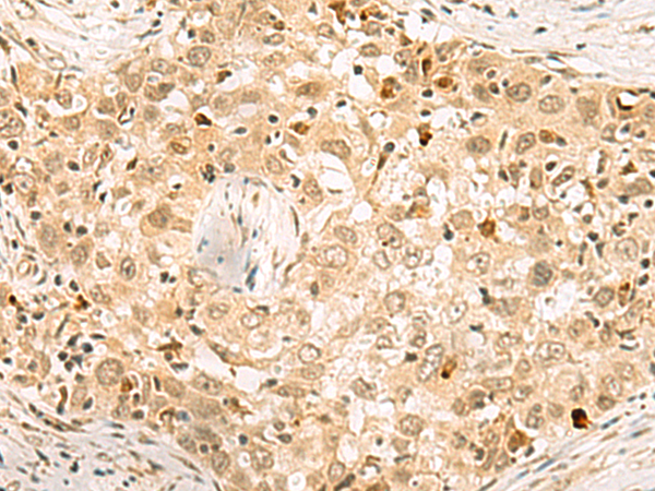 Immunohistochemistry of paraffin-embedded Human esophagus cancer tissue  using EXOSC4 Polyclonal Antibody at dilution of 1:70(×200)