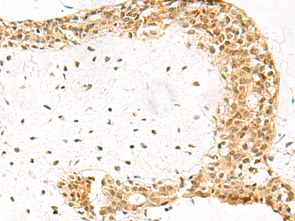 Immunohistochemistry of paraffin-embedded Human breast cancer tissue  using EXOSC4 Polyclonal Antibody at dilution of 1:70(×200)