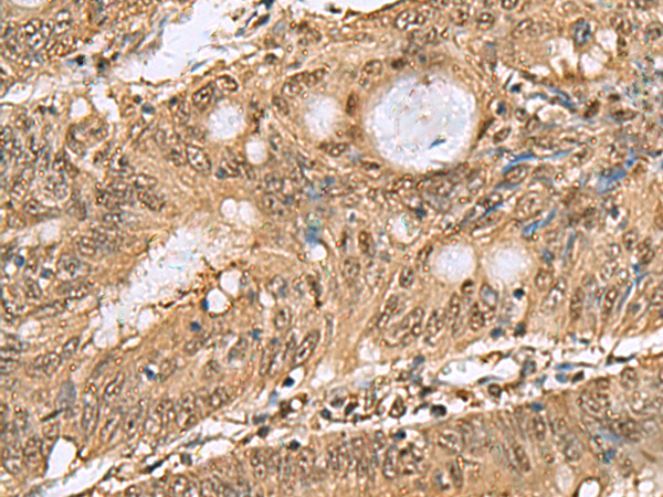 Immunohistochemistry of paraffin-embedded Human colorectal cancer tissue  using PSMA6 Polyclonal Antibody at dilution of 1:65(×200)