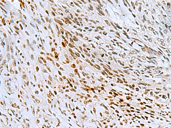 Immunohistochemistry of paraffin-embedded Human lung cancer tissue  using CNOT7 Polyclonal Antibody at dilution of 1:55(×200)