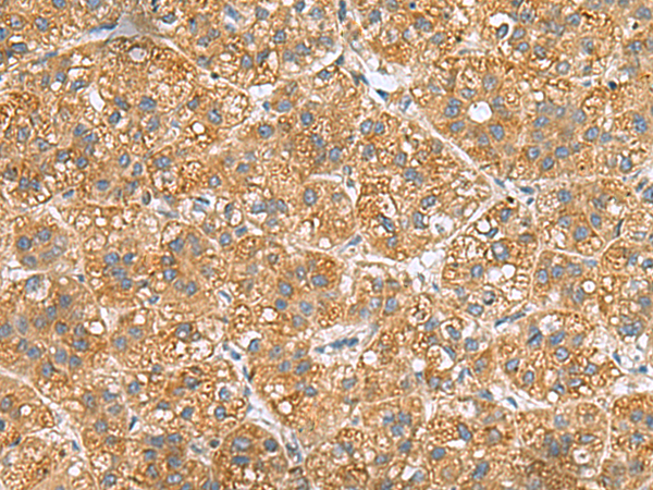 Immunohistochemistry of paraffin-embedded Human liver cancer tissue  using PPM1M Polyclonal Antibody at dilution of 1:50(×200)