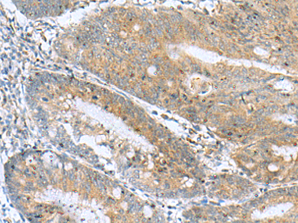 Immunohistochemistry of paraffin-embedded Human colorectal cancer tissue  using NANP Polyclonal Antibody at dilution of 1:50(×200)