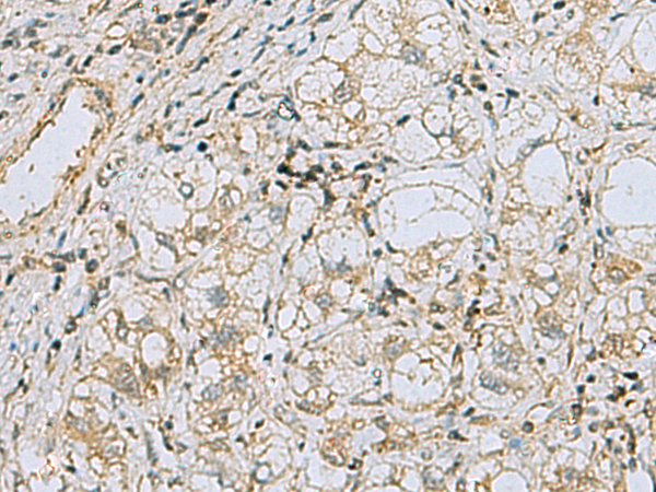 Immunohistochemistry of paraffin-embedded Human liver cancer tissue  using RAB3IP Polyclonal Antibody at dilution of 1:60(×200)