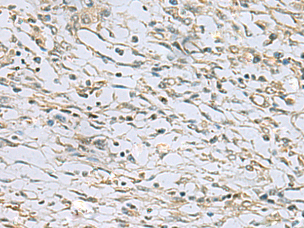 Immunohistochemistry of paraffin-embedded Human prost ate cancer tissue  using RAB3IP Polyclonal Antibody at dilution of 1:60(×200)