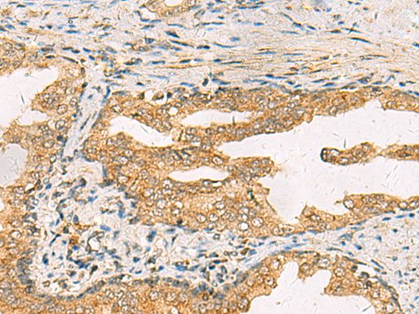 Immunohistochemistry of paraffin-embedded Human prost ate cancer tissue  using STX6 Polyclonal Antibody at dilution of 1:45(×200)