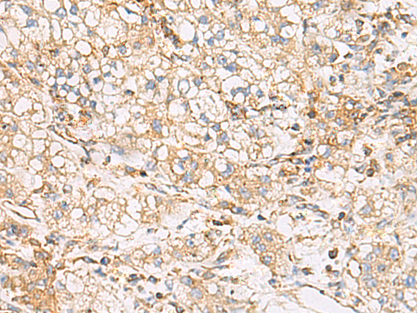 Immunohistochemistry of paraffin-embedded Human liver cancer tissue  using FYCO1 Polyclonal Antibody at dilution of 1:60(×200)