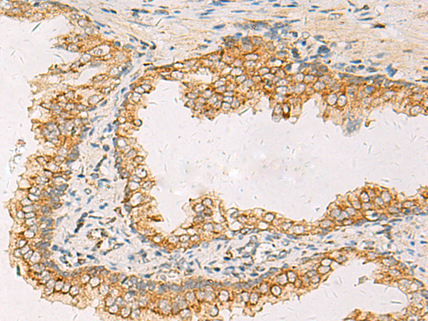 Immunohistochemistry of paraffin-embedded Human prost at e cancer tissue  using SUSD3 Polyclonal Antibody at dilution of 1:85(×200)