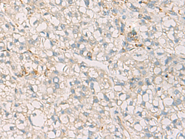 Immunohistochemistry of paraffin-embedded Human liver cancer tissue  using SUSD3 Polyclonal Antibody at dilution of 1:85(×200)