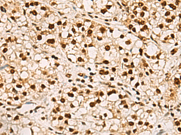 Immunohistochemistry of paraffin-embedded Human liver cancer tissue  using ELF5 Polyclonal Antibody at dilution of 1:75(×200)