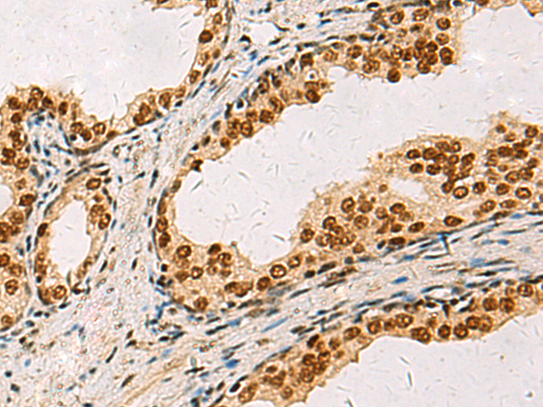 Immunohistochemistry of paraffin-embedded Human prost ate cancer tissue  using ELF5 Polyclonal Antibody at dilution of 1:75(×200)