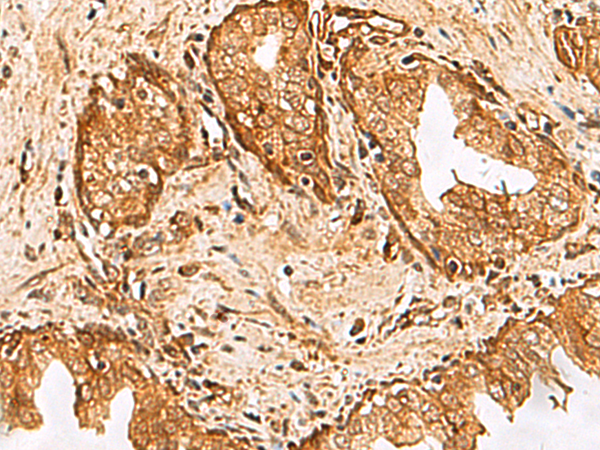 Immunohistochemistry of paraffin-embedded Human prost at e cancer tissue  using DHRS2 Polyclonal Antibody at dilution of 1:55(×200)