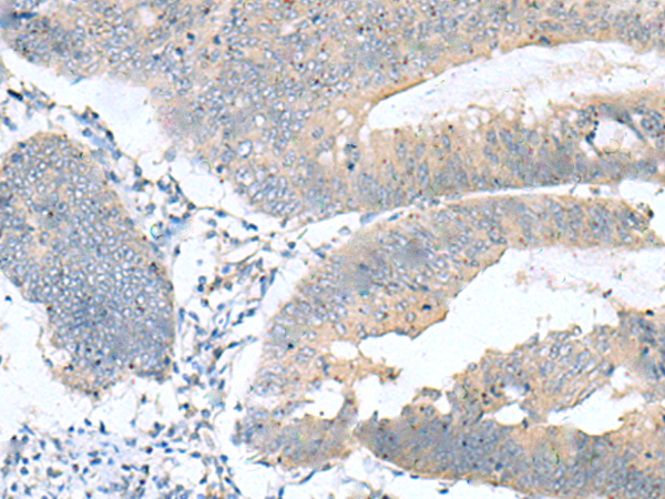 Immunohistochemistry of paraffin-embedded Human colorectal cancer tissue  using KRCC1 Polyclonal Antibody at dilution of 1:60(×200)