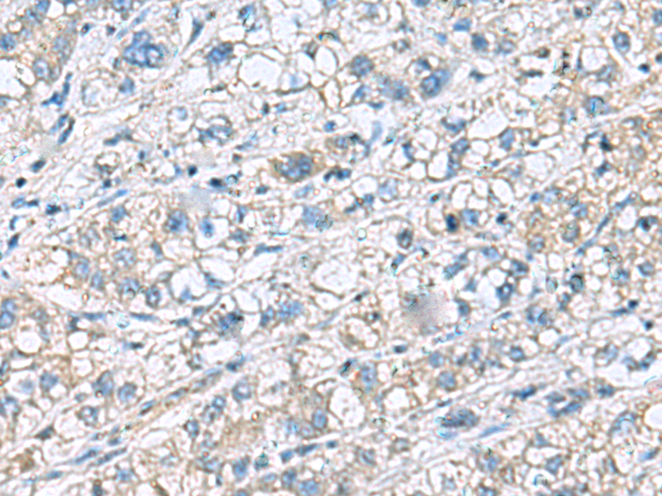 Immunohistochemistry of paraffin-embedded Human liver cancer tissue  using KRCC1 Polyclonal Antibody at dilution of 1:60(×200)